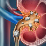 How to Prevent Kidney Stones?